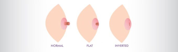 Breast problems